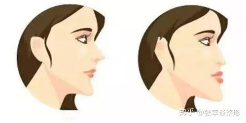 小鼻子整形手术:小鼻子整形手术,重塑面部和谐的科学选择 小鼻子整形手术:小鼻子整形手术,重塑面部和谐的科学选择