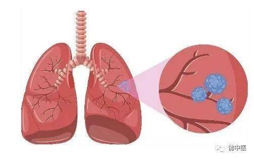 三个动作消除肺结节:肺结节困扰?这三个黄金动作或可助你降低风险,积极应对! 三个动作消除肺结节:肺结节困扰?这三个黄金动作或可助你降低风险,积极应对!