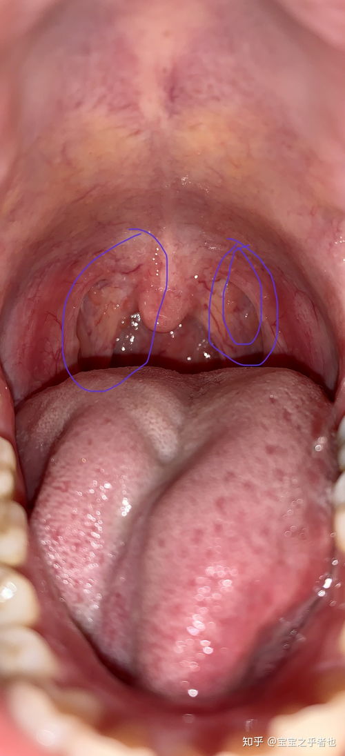 喉咙肿了像一块肉堵着：喉咙肿了像一块肉堵着，这些原因和应对方法你必须知道！