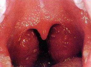 喉咙肿了像一块肉堵着：喉咙肿了像一块肉堵着，这些原因和应对方法你必须知道！