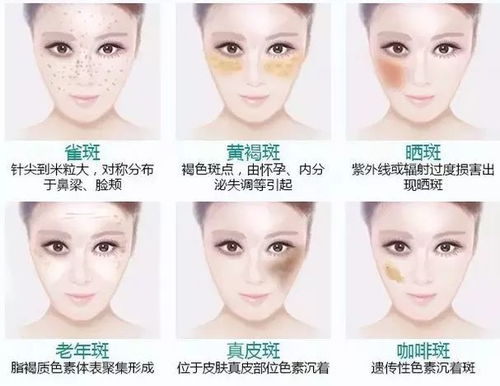 黄褐斑是什么原因造成的：黄褐斑是什么原因造成的？揭开斑点背后的真相