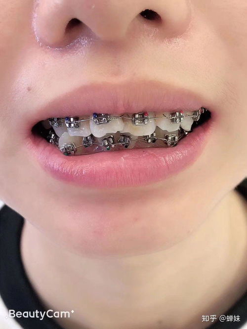 12岁戴牙套多少钱:震惊!12岁孩子戴牙套到底要花多少钱? 12岁戴牙套多少钱:震惊!12岁孩子戴牙套到底要花多少钱?