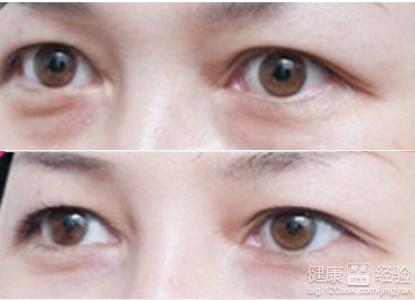 吉尔娜去眼袋怎么样：吉尔娜去眼袋怎么样？真实体验与效果解析
