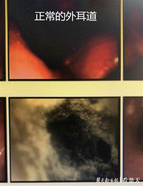 男性得了霉菌的症状：男性得了霉菌的症状有哪些？这些信号千万别忽视！