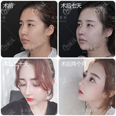 医美做鼻子多少钱：揭秘，医美做鼻子到底多少钱？价格差异背后的影响因素全解析