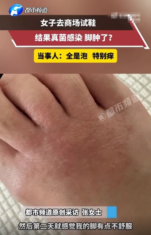 女生轻微脚气图片：认识女生轻微脚气，症状、原因与预防