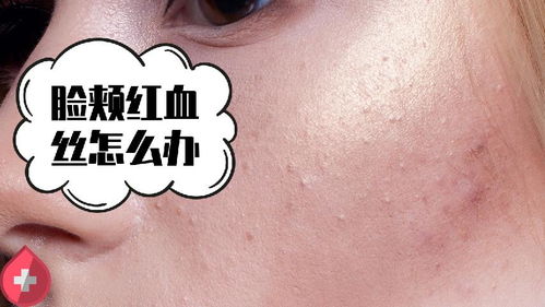 为什么会长痤疮的原因：揭秘痤疮的成因，为什么会长痘痘？
