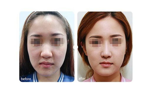 整骨脸部大概多少钱啊:整骨脸部价格解析,多少钱能换来理想轮廓? 整骨脸部大概多少钱啊:整骨脸部价格解析,多少钱能换来理想轮廓?