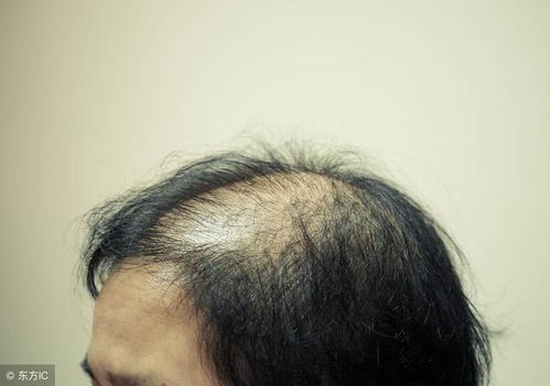 脂溢脱发是永久脱发吗：脂溢性脱发是永久脱发吗？答案在这里！