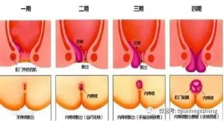 肛门出血鲜红色 没有疼痛：肛门出血鲜红色，没有疼痛？警惕这些原因！