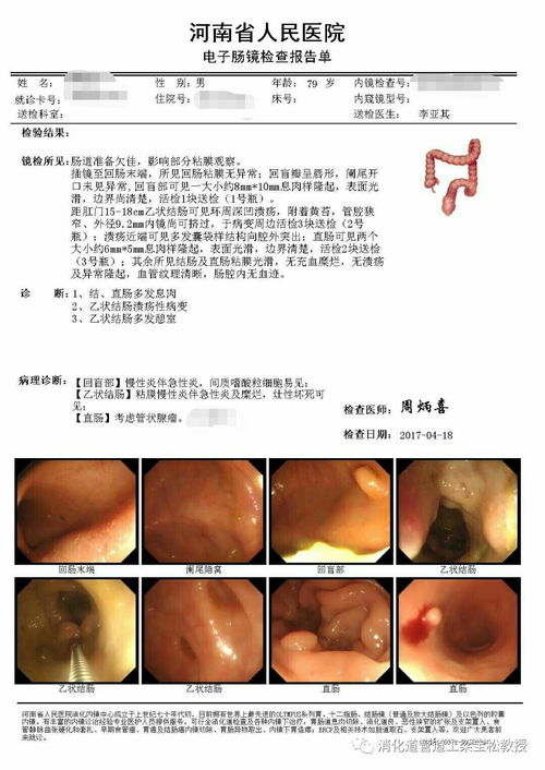 克罗恩病最常见的症状:克罗恩病的常见症状及表现 克罗恩病最常见的症状:克罗恩病的常见症状及表现