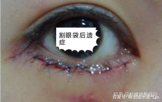 不用手术去眼袋是真的吗：不用手术去眼袋是真的吗？这些方法有效但需了解真相