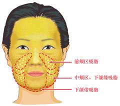 面部吸脂后特别后悔：面部吸脂后特别后悔，你真的准备好了吗？