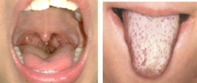 风寒感冒和风热感冒的区别和症状(风寒感冒和风热感冒的区别和症状有哪些) 风寒感冒和风热感冒的区别和症状(风寒感冒和风热感冒的区别和症状有哪些)