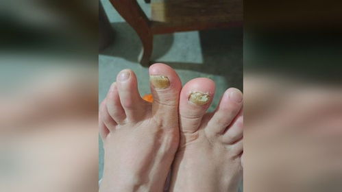 得了灰指甲怎么治疗最快：灰指甲快速治疗方法，告别困扰，重拾健康指甲