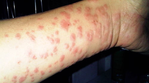 怎样治疗湿疹除根:湿疹根治指南,科学方法彻底摆脱困扰 怎样治疗湿疹除根:湿疹根治指南,科学方法彻底摆脱困扰