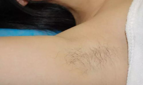 激光脱毛真的可以永久脱毛吗:激光脱毛真的可以永久脱毛吗? 激光脱毛真的可以永久脱毛吗:激光脱毛真的可以永久脱毛吗?