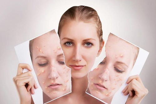 青春痘怎么改善:告别青春痘,实用方法改善皮肤状况 青春痘怎么改善:告别青春痘,实用方法改善皮肤状况