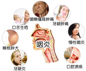 急性咽喉炎最好的治疗方法:急性咽喉炎,找到最佳治疗方案,快速缓解不适 急性咽喉炎最好的治疗方法:急性咽喉炎,找到最佳治疗方案,快速缓解不适