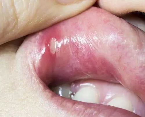 口腔溃疡吃什么维生素：口腔溃疡反复发作？这些维生素食物帮你快速修复！