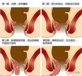痔疮长什么样?认识痔疮，形态与症状全解析