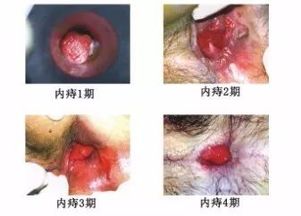 痔疮长什么样?认识痔疮，形态与症状全解析