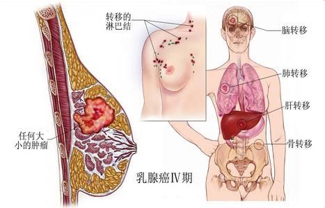 乳腺癌早期皮肤真人图片：乳腺癌早期皮肤变化，你必须知道的警示信号
