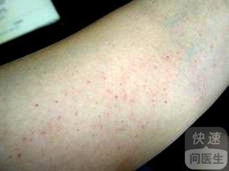 血小板减少性紫癜能根治吗(血小板减少性紫癜可以痊愈吗) 血小板减少性紫癜能根治吗(血小板减少性紫癜可以痊愈吗)