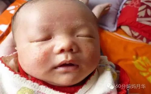 去除湿疹的简单方法:告别湿疹困扰,几个简单实用的家庭护理方法 去除湿疹的简单方法:告别湿疹困扰,几个简单实用的家庭护理方法