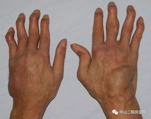 类风湿是怎么引起的：揭秘类风湿关节炎，复杂病因背后的真相