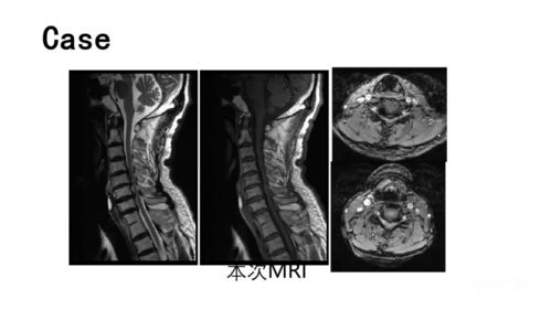 神经根型颈椎病:认识神经根型颈椎病,症状、诊断与治疗策略 神经根型颈椎病:认识神经根型颈椎病,症状、诊断与治疗策略