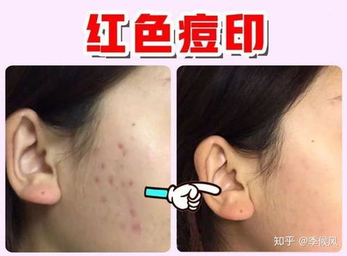 怎么除痘印怎么消除痘印:完全指南彻底告别痘印困扰,这些方法你必须知道!