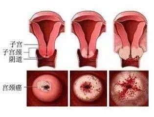 支原体和hpv哪个严重:支原体和HPV哪个更严重?从感染机制到健康管理的全面解析 支原体和hpv哪个严重:支原体和HPV哪个更严重?从感染机制到健康管理的全面解析