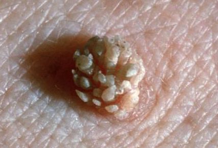 支原体和hpv哪个严重:支原体和HPV哪个更严重?从感染机制到健康管理的全面解析 支原体和hpv哪个严重:支原体和HPV哪个更严重?从感染机制到健康管理的全面解析