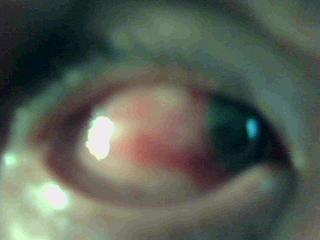 白眼球充血是怎么回事:白眼球充血是怎么回事?原因、症状与应对方法全解析 白眼球充血是怎么回事:白眼球充血是怎么回事?原因、症状与应对方法全解析