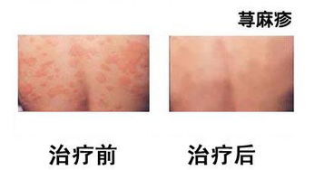 荨麻疹是怎么引起的及治疗方法：荨麻疹是怎么引起的？这些治疗方法你一定要知道！