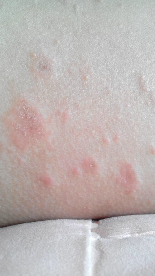 荨麻疹是怎么引起的及治疗方法：荨麻疹是怎么引起的？这些治疗方法你一定要知道！