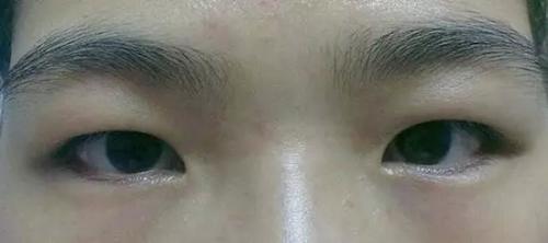 肿眼泡割双眼皮案例:肿眼泡割双眼皮案例分享,真实效果对比与术后恢复全记录 肿眼泡割双眼皮案例:肿眼泡割双眼皮案例分享,真实效果对比与术后恢复全记录