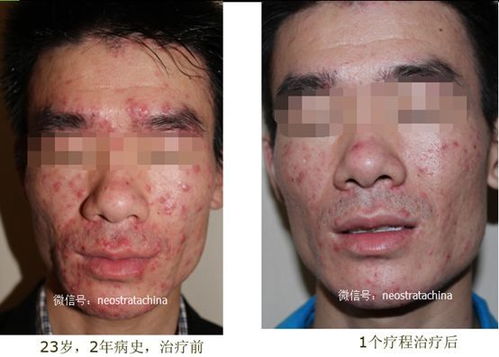 果酸换肤的后遗症危害:警惕果酸换肤的后遗症危害,美丽需谨慎 果酸换肤的后遗症危害:警惕果酸换肤的后遗症危害,美丽需谨慎