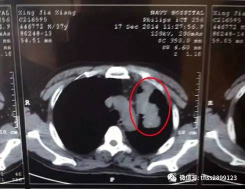 2厘米胆结石自己消失了:医学奇迹?2厘米胆结石自行消失,专家解答背后的科学原因 2厘米胆结石自己消失了:医学奇迹?2厘米胆结石自行消失,专家解答背后的科学原因