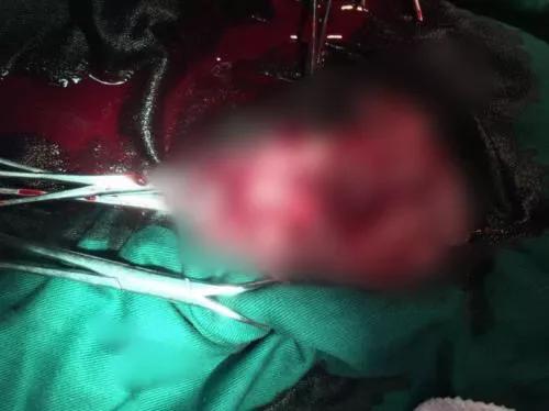 梦见拔牙出血是什么意思：解密梦境，梦见拔牙出血，你的潜意识在暗示什么？