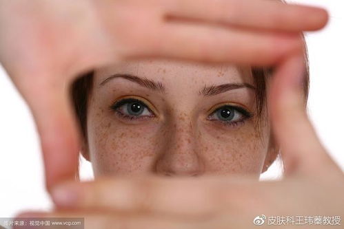 斑是怎么形成的:为什么会长斑?原来是这些原因在作怪! 斑是怎么形成的:为什么会长斑?原来是这些原因在作怪!