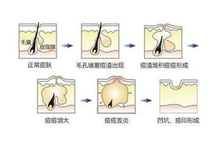 如何去掉痘印和痘坑:告别痘印痘坑!科学方法助你重塑无瑕肌肤 如何去掉痘印和痘坑:告别痘印痘坑!科学方法助你重塑无瑕肌肤