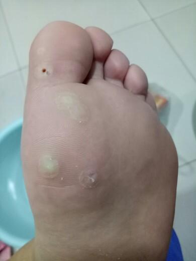 跖疣被取出样子的图片:跖疣手术后的真实变化,术后图片揭示恢复过程与效果 跖疣被取出样子的图片:跖疣手术后的真实变化,术后图片揭示恢复过程与效果