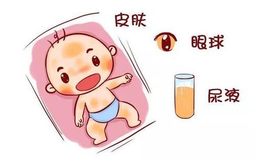 病理性黄疸:新生儿黄疸,认识与防治