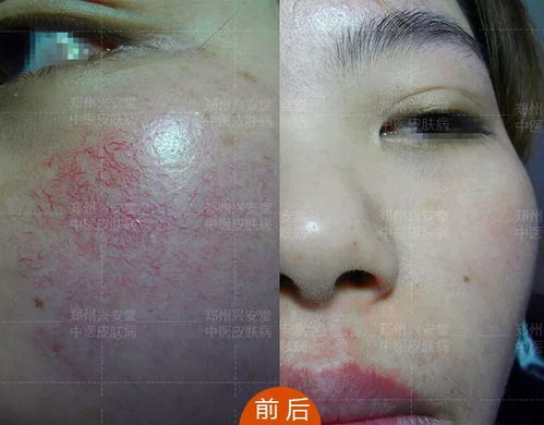 如何去红血丝:告别恼人红血丝,全面指南教你如何改善红血丝问题