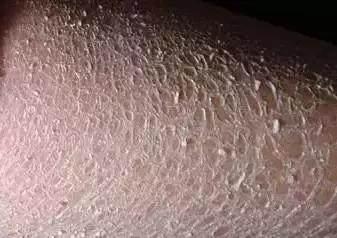 鱼鳞皮肤病怎么根治:鱼鳞病治疗的最新进展与有效管理策略