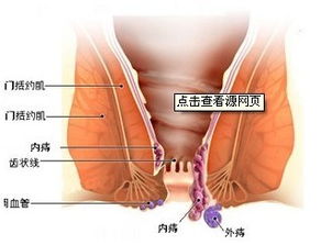 怎么知道是内痔还是外痔:如何区分内痔和外痔?这些症状和检查方法帮你判断
