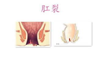 拉屎肛门疼撕裂出血:警惕!排便后肛门剧痛并见血,可能是肛裂或其他肛肠问题的信号