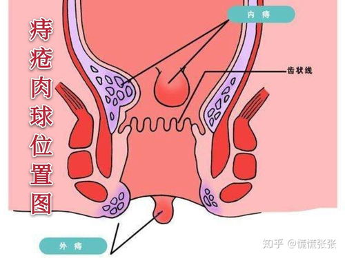 痔疮手术需要多少钱:痔疮手术需要多少钱?费用构成与影响因素全解析 痔疮手术需要多少钱:痔疮手术需要多少钱?费用构成与影响因素全解析